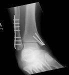 X ray of leg.jpg